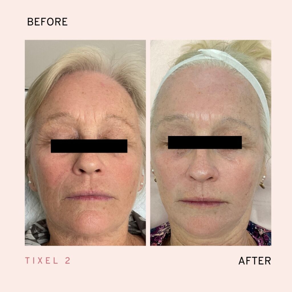 two Tixel treatments